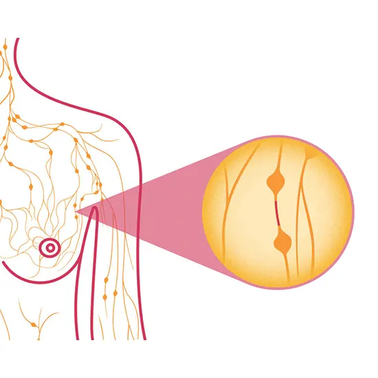 inflammatory breast cancer